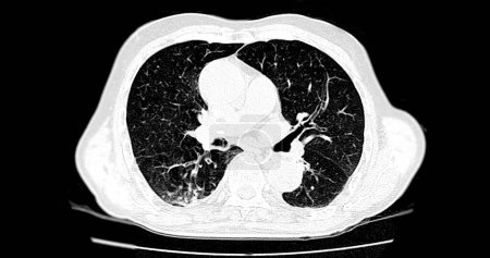 Photo for CT scan of Chest axial view for diagnostic Pulmonary embolism (PE) , lung cancer and covid-19. - Royalty Free Image