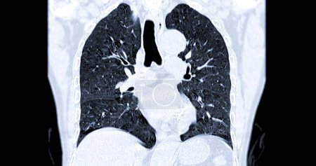 Téléchargez les photos : CT scan of Chest coronal view for diagnostic Embolie pulmonaire (EP), cancer du poumon et covide-19. - en image libre de droit