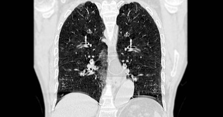 Foto de Tomografía computarizada de la vista coronal del tórax para diagnóstico Embolia pulmonar (EP), cáncer de pulmón y covid-19. - Imagen libre de derechos