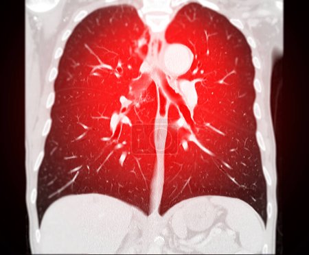 Photo for CT scan of Chest coronal view for diagnostic Pulmonary embolism (PE) , lung cancer and covid-19. - Royalty Free Image