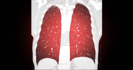 Photo for CT scan of Chest coronal view for diagnostic Pulmonary embolism (PE) , lung cancer and covid-19. - Royalty Free Image