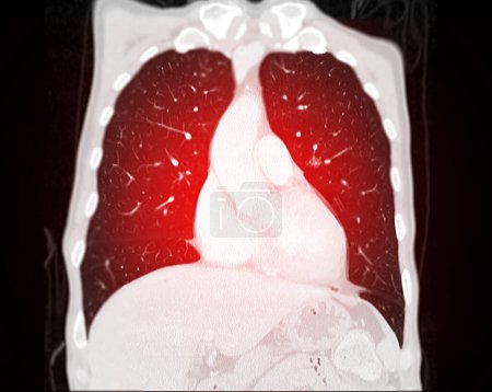 Foto de Tomografía computarizada de la vista coronal del tórax para diagnóstico Embolia pulmonar (EP), cáncer de pulmón y covid-19. - Imagen libre de derechos
