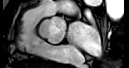 Photo for MRI heart or Cardiac MRI ( magnetic resonance imaging ) of heart showing aortic valve . - Royalty Free Image