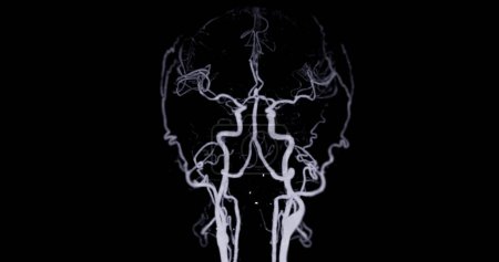 Foto de CTA CABELLO o angiografía por TC de la imagen de la técnica de PMI cerebral AP y vista lateral que muestra arteria cerebral. - Imagen libre de derechos
