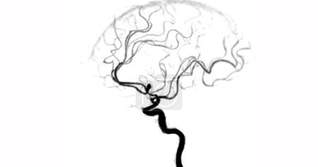 Foto de CTA CEREBRO o angiografía por TC de la vista del angiograma cerebral que muestra arteria cerebral. - Imagen libre de derechos