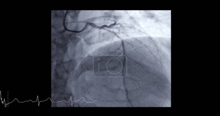 Téléchargez les photos : Le cathétérisme cardiaque sur l'artère descendante antérieure gauche peut aider le médecin à diagnostiquer et à traiter les problèmes dans votre cœur et vos vaisseaux sanguins tels qu'une crise cardiaque ou un accident vasculaire cérébral.. - en image libre de droit
