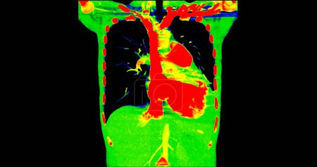 Photo for CT scan of Chest coronal view in color mode  for diagnostic Pulmonary embolism (PE) , lung cancer and covid-19. - Royalty Free Image