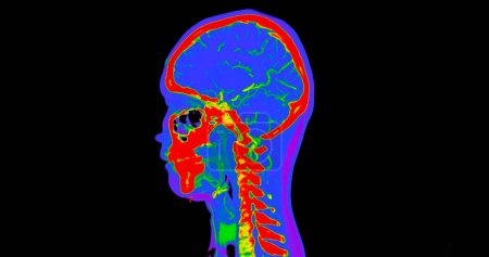 CT angiography of the brain or CTA brain and neck Sagittal view 3D Rendering image fusion color mode . medical technology concept.