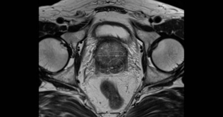 Foto de RM de la glándula prostática axial T2W para el diagnóstico de células cancerosas de próstata en hombres ancianos. - Imagen libre de derechos