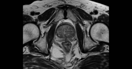 Foto de RM de la glándula prostática axial T2W para el diagnóstico de células cancerosas de próstata en hombres ancianos. - Imagen libre de derechos
