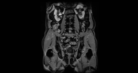 Foto de IRM glándula prostática coronal T2W para el diagnóstico de células cancerosas de próstata en hombres ancianos. - Imagen libre de derechos