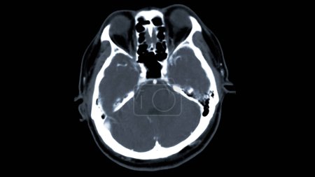 Foto de Tomografía computarizada del cerebro con medios de contraste de inyección para el diagnóstico de tumores cerebrales, derrames cerebrales y enfermedades vasculares. - Imagen libre de derechos