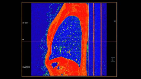 Téléchargez les photos : CT scan of Chest coronal view in color mode for diagnostic Embolie pulmonaire (EP), cancer du poumon et covide-19. - en image libre de droit