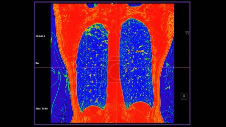 Foto de Tomografía computarizada de la vista coronal del tórax en modo de color para el diagnóstico de embolia pulmonar (EP), cáncer de pulmón y covid-19. - Imagen libre de derechos
