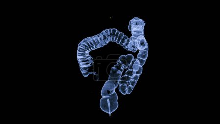 Téléchargez les photos : CT colonographie Image de rendu 3D pour les bilans de santé annuels pour dépister le cancer du côlon. - en image libre de droit