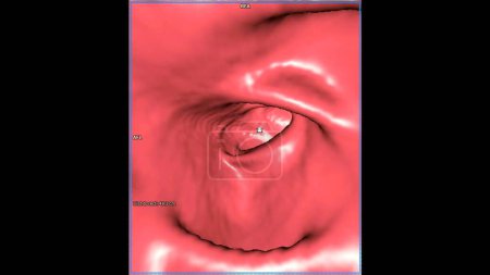 Téléchargez les photos : CT colonographie Image de rendu 3D pour les bilans de santé annuels pour dépister le cancer du côlon. - en image libre de droit