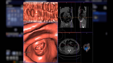 Téléchargez les photos : CT colonography compare 2D Axial, sagittal, plan coronal et image de rendu 3D pour le dépistage du cancer colorectal. Pour les bilans de santé annuels pour dépister le cancer du côlon. - en image libre de droit
