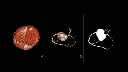 Photo for CT Cardiac 3D rendering  or CTA coronary artery for prevention coronary artery diseases. - Royalty Free Image