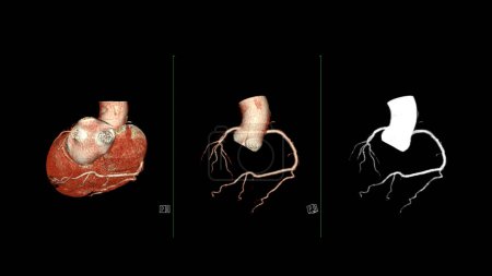 Photo for CT Cardiac 3D rendering  or CTA coronary artery for prevention coronary artery diseases. - Royalty Free Image