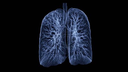 Photo for CT Chest or CT lung 3d rendering image with blue color showing Trachea and lung in respiratory system. - Royalty Free Image
