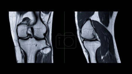 Photo for Magnetic resonance imaging of knee joint or MRI knee sagittal for detect tear or sprain of the anterior cruciate ligament (ACL). - Royalty Free Image