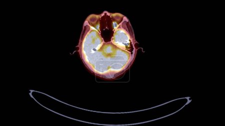 Téléchargez les photos : PET CT image de tout le corps humain Plan axial. Tomodensitométrie par émission de positrons . - en image libre de droit