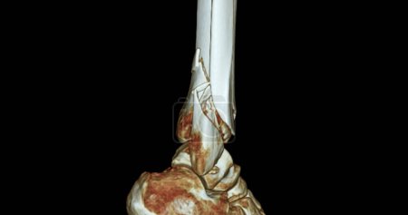 Photo for CT Scan ankle joint  3D  Rendering image showing fracture tibia and fibula bone. - Royalty Free Image