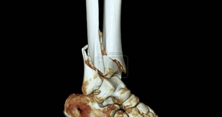 Photo for CT Scan ankle joint  3D  Rendering image showing fracture tibia and fibula bone. - Royalty Free Image