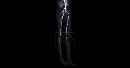 Foto de CTA arteria femoral se desprende de la imagen de la arteria femoral para el diagnóstico Enfermedad arterial periférica aguda o crónica. - Imagen libre de derechos
