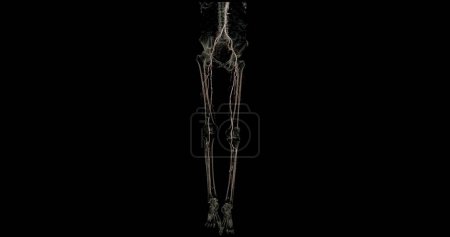 Photo for CTA femoral artery run off image of femoral artery for diagnostic Acute or Chronic Peripheral Arterial Disease. - Royalty Free Image