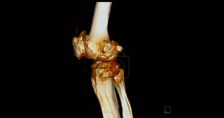 Photo for CT Scan of Knee joint showing fracture tibia and fibula bone 3D rendering. - Royalty Free Image
