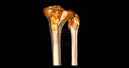 Photo for CT Scan of Knee joint showing fracture tibia and fibula bone 3D rendering. - Royalty Free Image