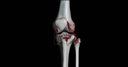 CT Analyse de l'articulation du genou montrant une fracture du tibia et de l'os du péroné rendu 3D.
