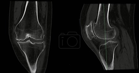 Photo for CT Scan of Knee joint sagittal and coronal in case fracture patella bone. - Royalty Free Image