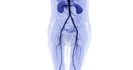 Foto de CTA arteria femoral se desprende de la imagen de la arteria femoral para el diagnóstico Enfermedad arterial periférica aguda o crónica. - Imagen libre de derechos