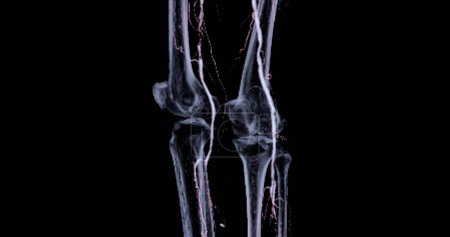 Photo for CTA femoral artery run off image of femoral artery for diagnostic Acute or Chronic Peripheral Arterial Disease. - Royalty Free Image