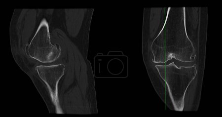 Photo for CT Scan of Knee joint sagittal and coronal in case fracture patella bone. - Royalty Free Image