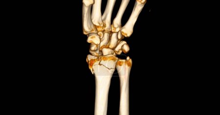 Photo for CT scan of wrist joint 3D rendering for diagnosis wrist joint pain. - Royalty Free Image