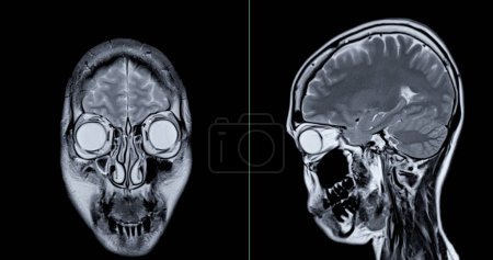 Photo for MRI scan of the  brain   for detect  Brain  diseases sush as stroke disease, Brain tumors and Infections. - Royalty Free Image