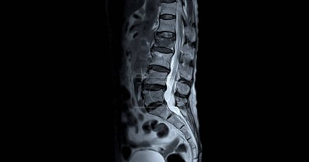 Foto de Resonancia magnética L-S columna vertebral o columna lumbar sagital T2W ver para el diagnóstico compresión de la médula espinal. - Imagen libre de derechos
