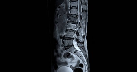 Photo for MRI L-S spine or lumbar spine sagittal T2W view  for diagnosis spinal cord compression. - Royalty Free Image