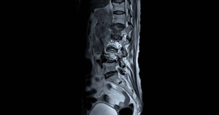 Photo for MRI L-S spine or lumbar spine sagittal T2W view  for diagnosis spinal cord compression. - Royalty Free Image