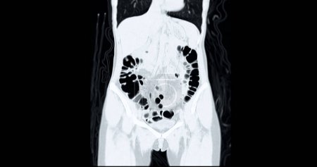 Téléchargez les photos : CT Colonoscopie vue coronale .Fond médical. - en image libre de droit