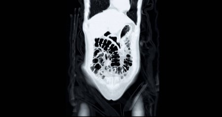 Téléchargez les photos : CT Colonoscopie vue coronale .Fond médical. - en image libre de droit
