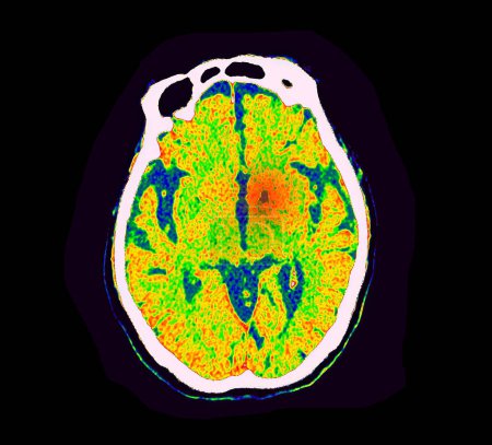 Foto de CT Perfusión cerebral o tomografía computarizada imagen de la vista axial cerebral que muestra el flujo sanguíneo cerebral en el monitor en el área del accidente cerebrovascular. - Imagen libre de derechos