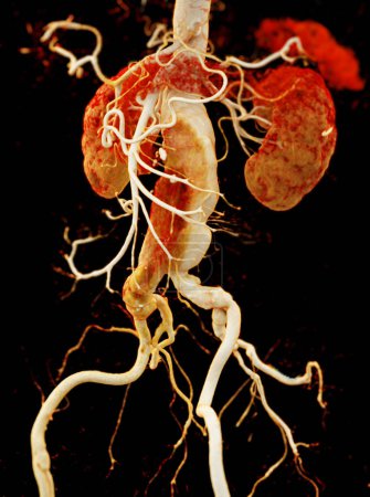Téléchargez les photos : CTA aorte abdominale montrant une dissection aortique abdominale rendu 3D. - en image libre de droit