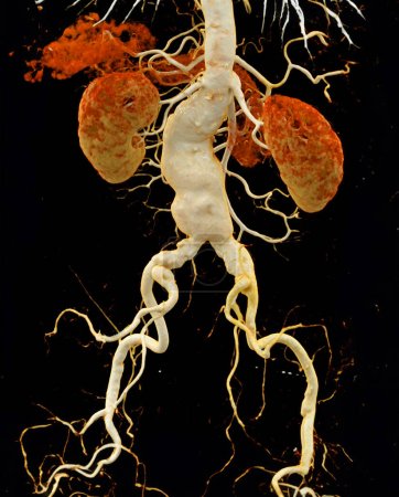 Téléchargez les photos : CTA aorte abdominale montrant une dissection aortique abdominale rendu 3D. - en image libre de droit