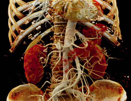 Foto de CTA La arteria renal es un procedimiento de imagen médica que utiliza tomografías computarizadas para examinar las arterias renales. Proporciona imágenes detalladas de los vasos sanguíneos que irrigan los riñones.. - Imagen libre de derechos