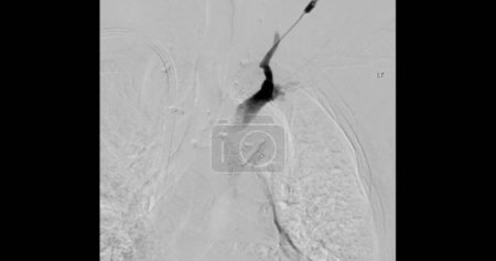 Photo for Balloon Angioplasty is a medical procedure used to widen narrowed or blocked blood vessels. - Royalty Free Image