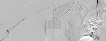 Photo for Balloon Angioplasty is a medical procedure used to widen narrowed or blocked blood vessels. - Royalty Free Image